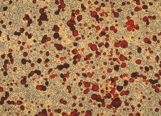 膠滴腫瘤藥敏檢測技術(shù)檢測及評價不同藥物濃度的5'-DFUR對胃癌的療效（一）